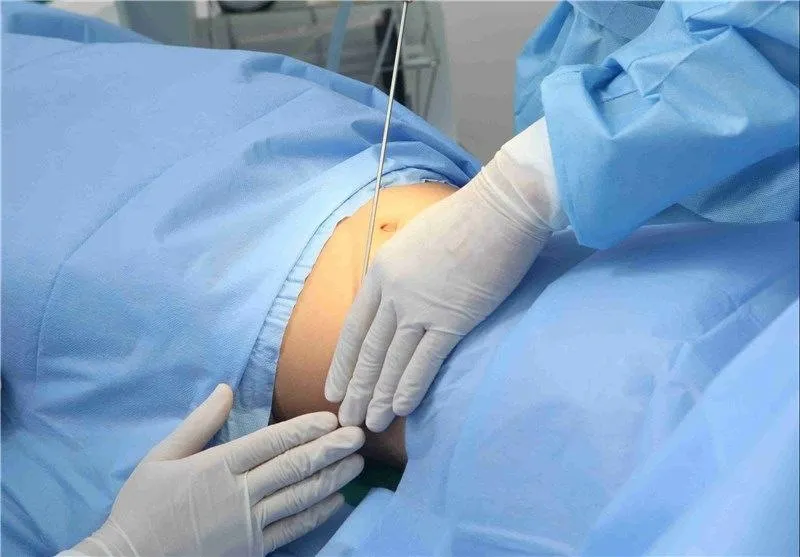 مزوتزاپی لاغری