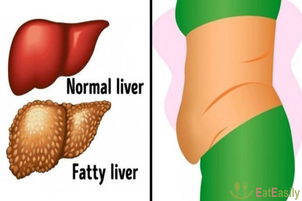رژیم لاغری آسان برای درمان کبد چرب